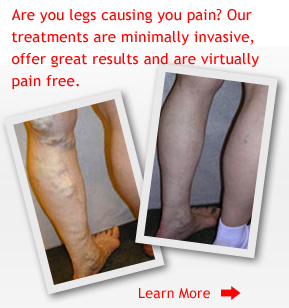 Varicose Vein Pain