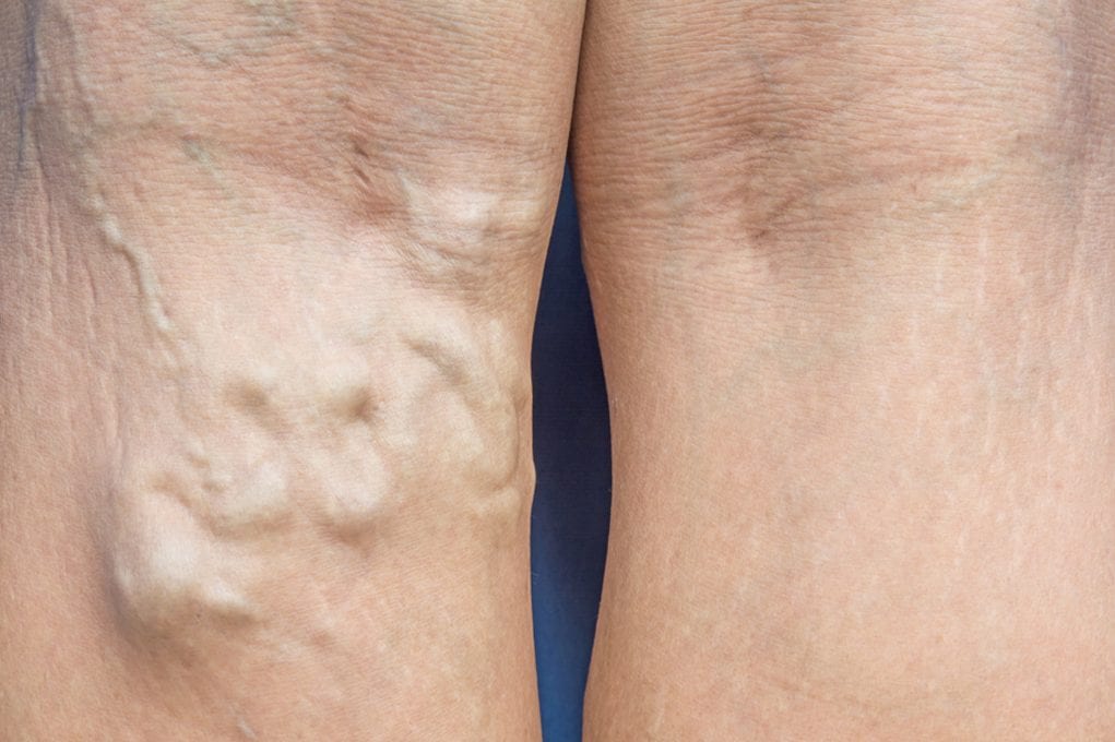 Varicose Veins of the Leg