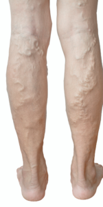 Lower Leg Varicose