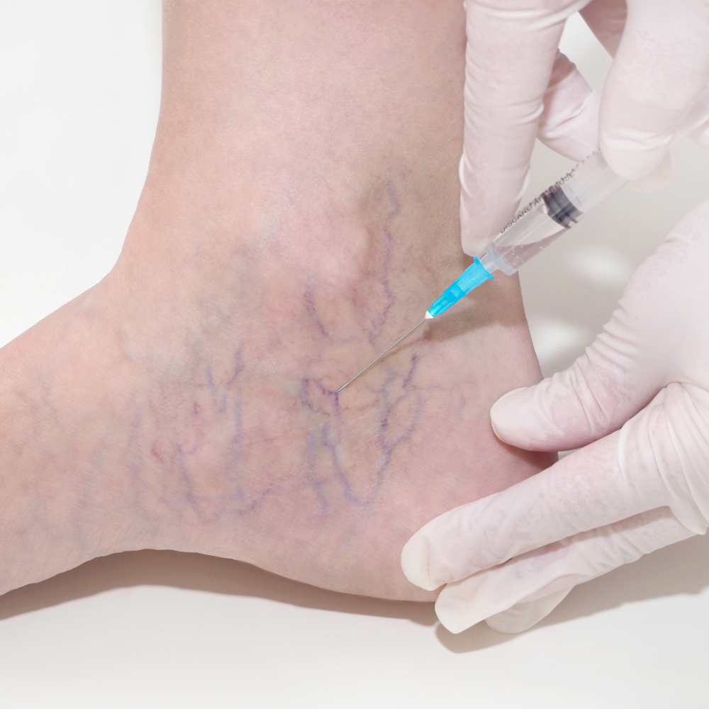 Sclerotherapy